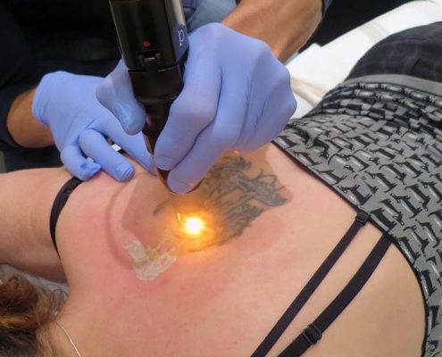Tattoo-Removal